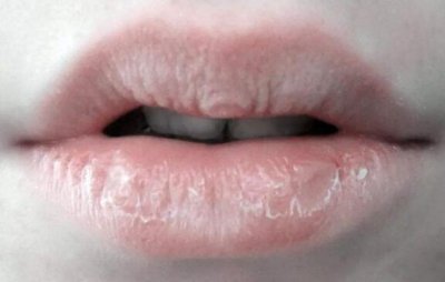 嘴唇老是干燥起皮是什么原因 嘴唇干燥起皮是什么原因？怎么办