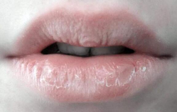 嘴唇干燥起皮是什么原因？怎么办