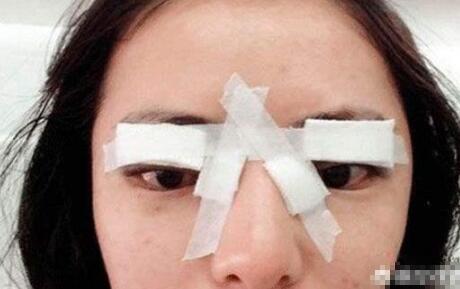 双眼皮手术后如何护理和注意事项