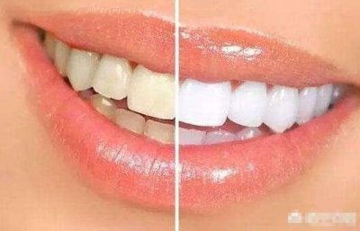 牙齿变黄怎样才能变白 牙齿很黄怎么变白的简单方法