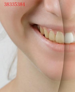 关于洗牙的五大误区 你中招了吗？