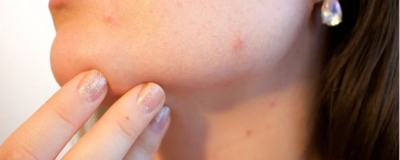 皮肤暗沉有痘印怎么办 肌肤的护理方法