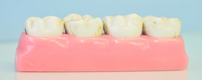 快速美白牙齿的方法 牙齿变黄的原因有哪些